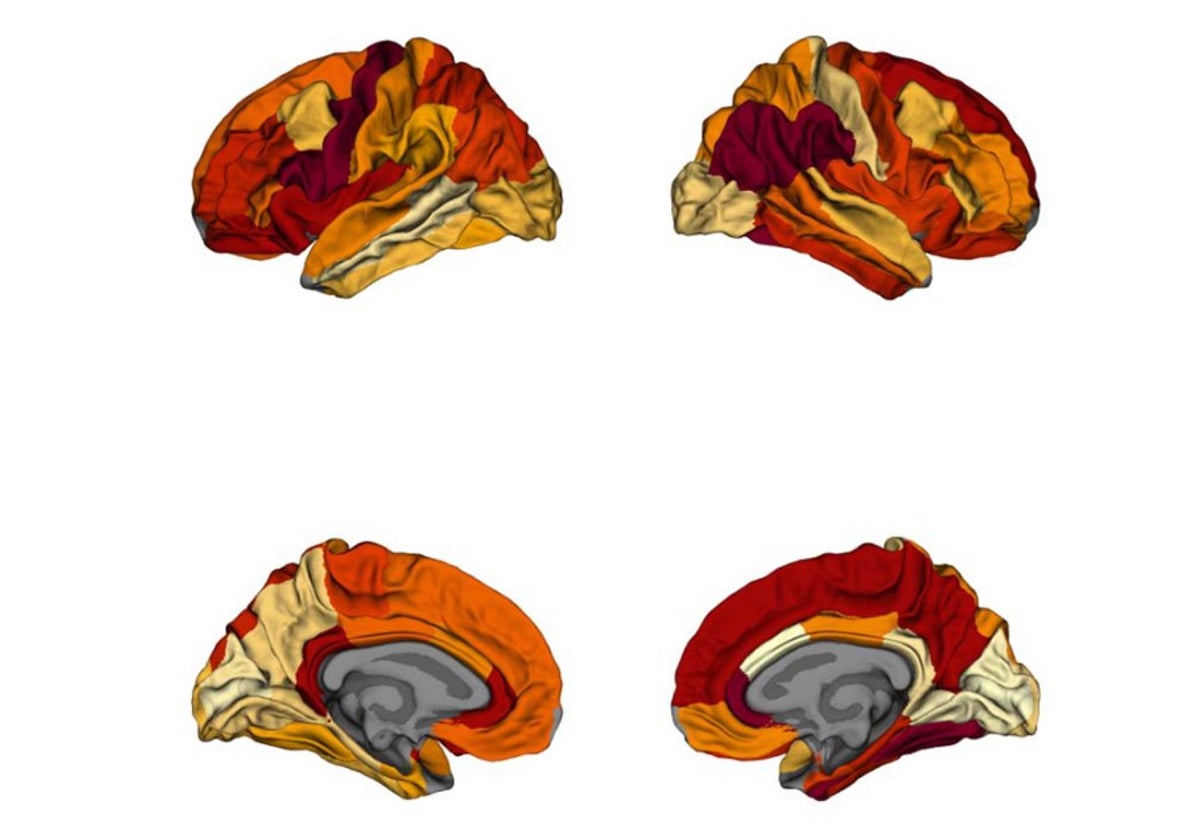 La obesidad puede causar una neurodegeneración similar al alzhéimer