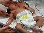 Un bebé con dos cabezas en China