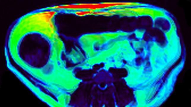 Prueban con éxito un fármaco para adelgazar que «mata de hambre» a la grasa