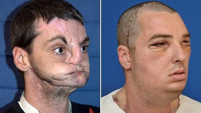 Un hospital de EE.UU. consigue el «mayor trasplante de cara» jamás realizado