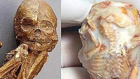 Una anciana da a luz a un bebé fósil 56 años después