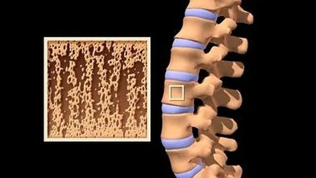 La NASA crea un test de orina para detectar la osteoporosis