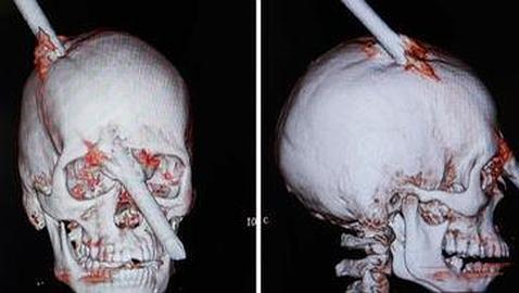 Un obrero brasileño sobrevive, de milagro, a una perforación craneal con una barra de acero