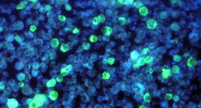 Descubren una de las vías por las que la inflamación causa cáncer