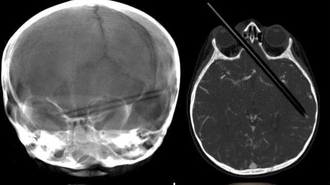 Una niña se clava por accidente un lápiz en el ojo y le atraviesa los dos hemisferios del cerebro
