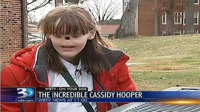 Cassidy Hooper, la adolescente de EE.UU. que no tiene ojos ni nariz
