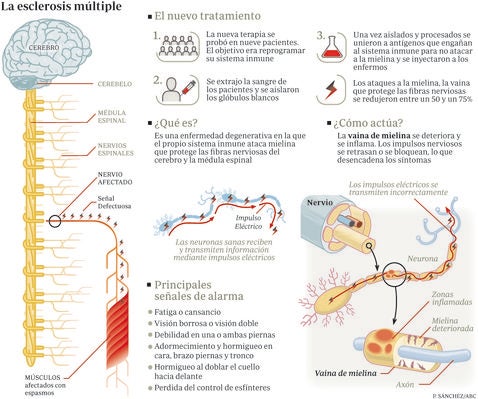 Prueban con éxito una terapia esperanzadora contra la esclerosis múltiple