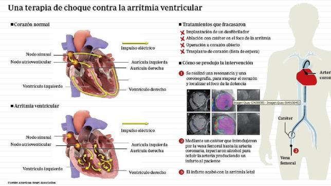 Un ataque al corazón que salva vidas