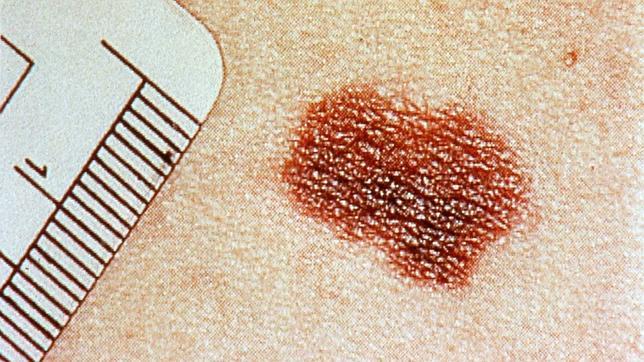 Un melanoma, tumor cutáneo asociado a la exposición al Sol