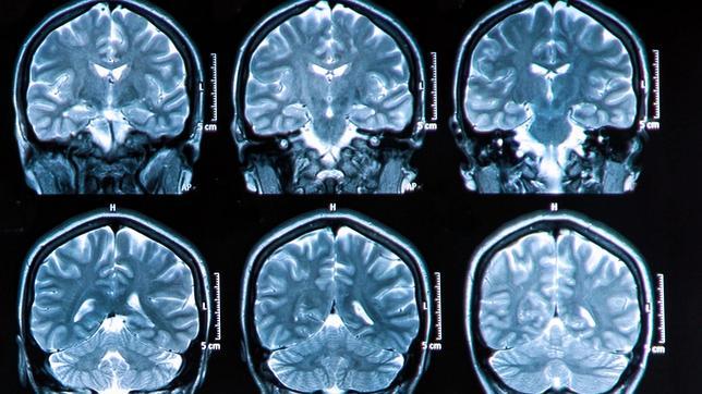 En el alzhéimer, dos peor que uno