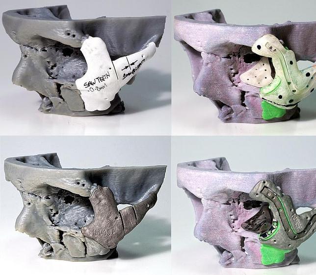 La impresión en 3D reconstruye el rostro desfigurado de un paciente