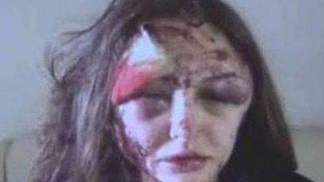 Un millonario ruso huye tras desfigurar el rostro a su novia, la modelo Alexandra Sereda