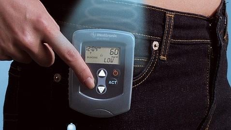 Las bombas de insulina mejoran el control del azúcar en diabetes tipo 2