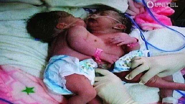Nacen dos siamesas en Bolivia unidas por el hígado y el corazón