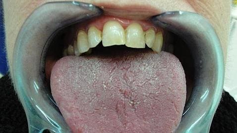 La 'boca seca' puede ser un síntoma de padecer asma