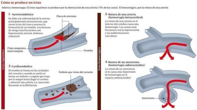 Hallan un gen ligado con un mayor riesgo de una de las causas de ictus en jóvenes