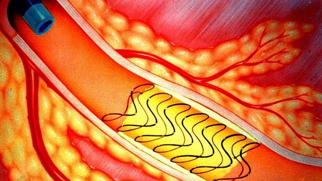 El «stent» es una malla, una prótesis que mantiene abierta el interior de la arteria para evitar que se obstruya