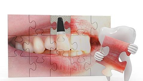 La importancia de la estética en los implantes dentales