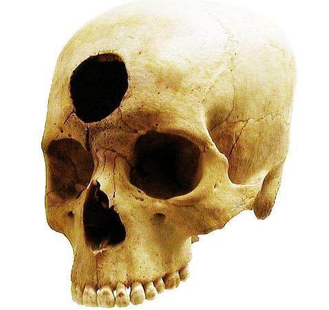 Ejemplo de trepanación