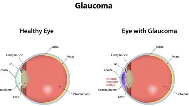 La hipertensión ocular daña el nervio óptico, pero no produce síntomas
