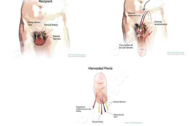 Médicos sudafricanos realizan con éxito el primer trasplante de pene del mundo