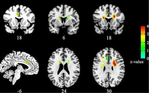 El estudio descubrió un incremento de la actividad en algunas áreas del cerebro de los enamorados