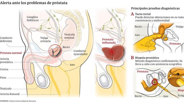 Una nueva técnica permite detectar sin las dolorosas biopsias el cáncer de próstata