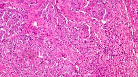 Muestra de un carcinoma medular de colon