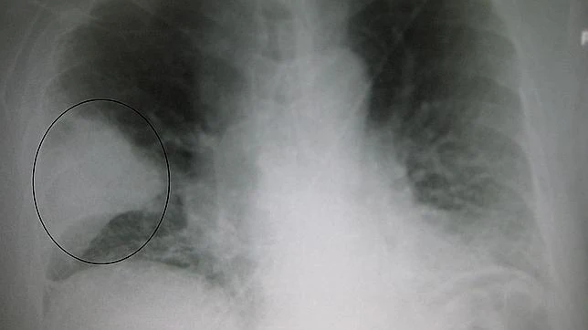 La enfermedad causa una acumulación de mucosidad en los pulmones