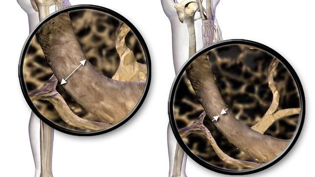 Un fármaco para la osteoporosis parece ser eficaz en el control de la diabetes