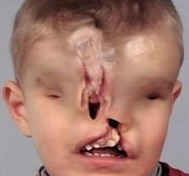 El extraño caso del niño que nació sin ojos, nariz ni boca