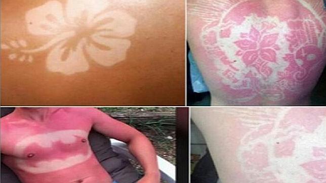 #SunburnArt, el arte de conseguir tatuajes quemándose la piel