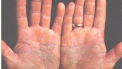 Úlcera crónicas en manos