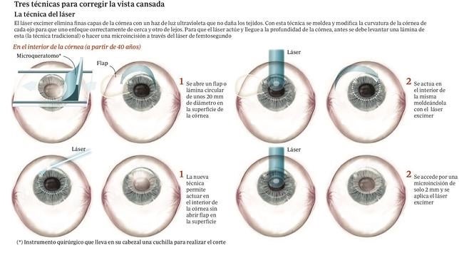 Las operaciones disponibles hoy para neutralizar la vista cansada