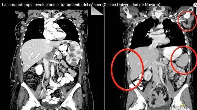 «La inmunoterapia está revolucionando el tratamiento del cáncer»