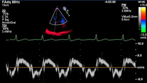 Un monitor recoge las variables de la actividad del corazón