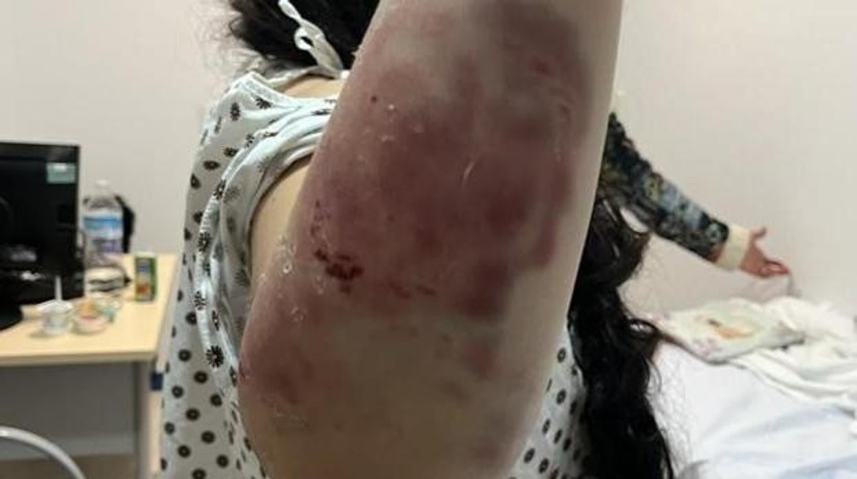 Moratones y heridas en el brazo de la menor víctima de maltrato