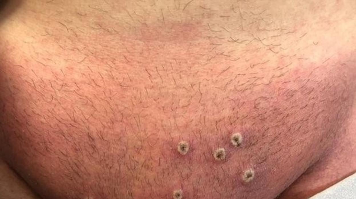 Heridas que produce la viruela del mono en una imagen de archivo