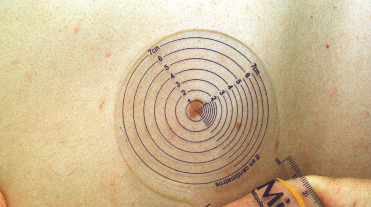 Medición médica de las dimensiones de un lunar