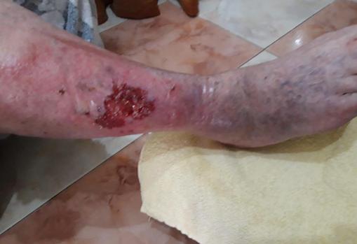 Herida de uno de los pacientes tratados por Agustina Roselló en Valme