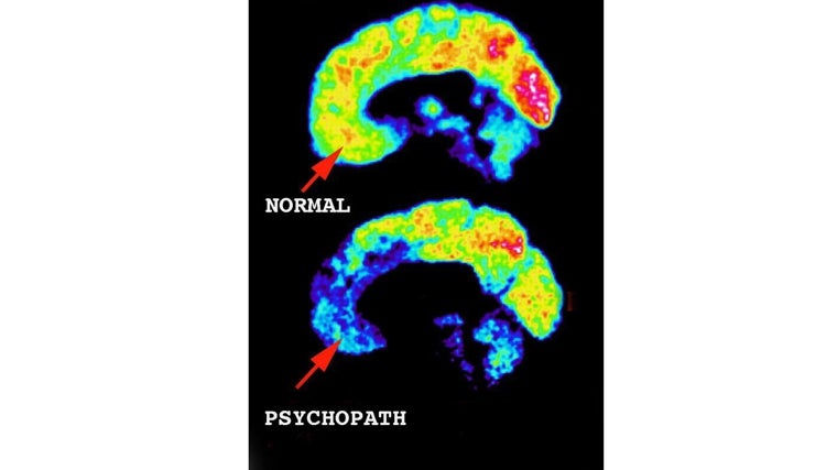 Imagen de un cerebro normal y el de un psicópata