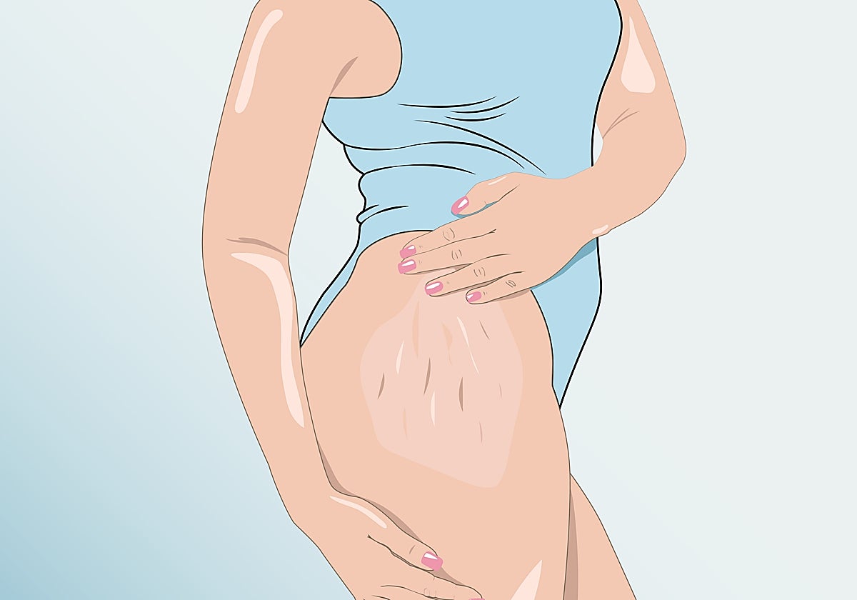 Cómo eliminar la celulitis.