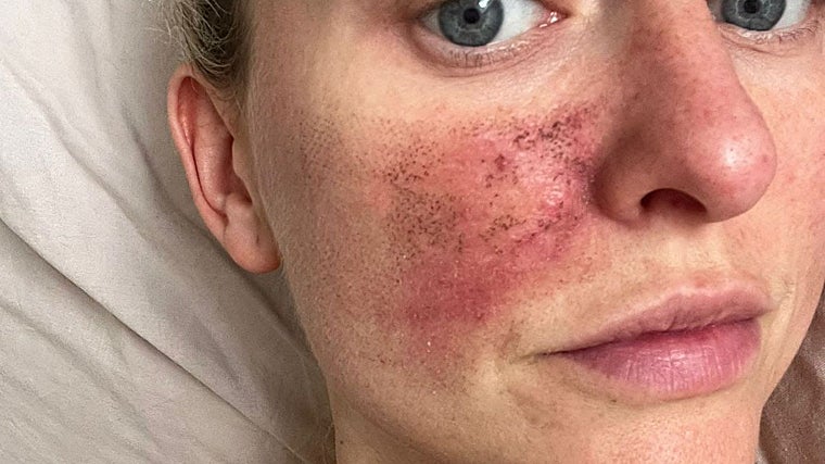 Holly após a segunda sessão