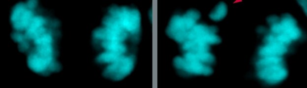 Lado izquierdo: imagen microscopica de los cromosomas de una célula madre neuro humana moderna de la neocorteza durante la división celular.  Lado derecho: mismo tipo de imagen, pero con variantes neandertales, con el doble de errores de separación cromosómica