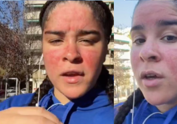 Soy alérgica al agua y así es mi día a día viviendo con esta enfermedad