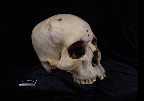 Cráneo y mandíbula del varón egipcio de hace 4.000 años afectado de cáncer