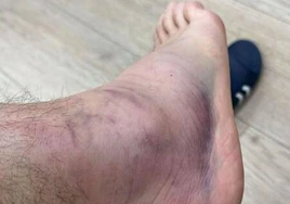 Así está el tobillo de Aitor Ruibal tras su lesión ante el Betis - Athletic