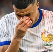 Kylian Mbappé tiene la nariz rota, aunque no tendrá que pasar por el quirófano
