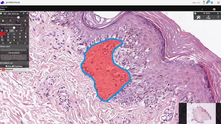 Imagen histológica de una biopsia analizada por la IA de esta spin-off nacida de la Universidad Politécnica de Valencia