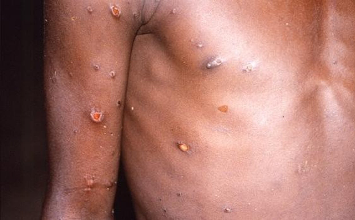 La vacuna contra la viruela del mono ya está disponible en la Comunidad de Madrid